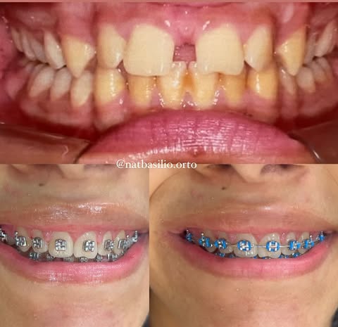 Antes e Depois 2