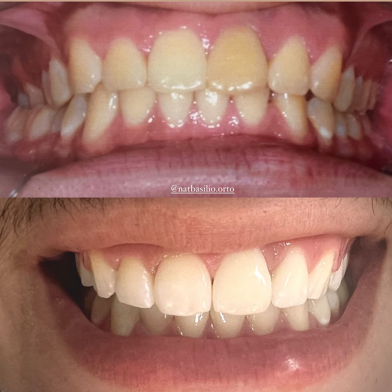 Antes e Depois 1