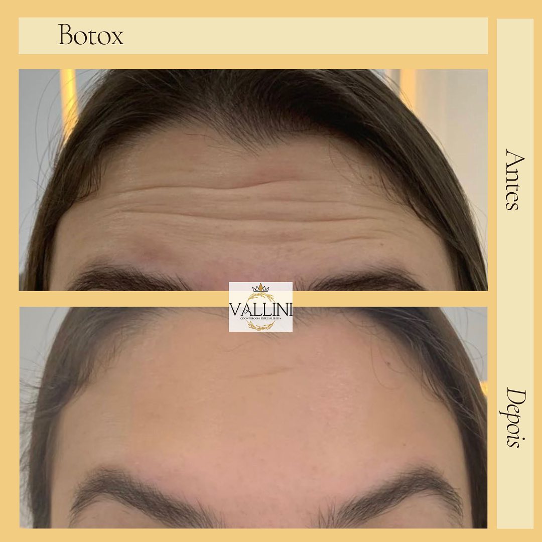 Antes e Depois 4
